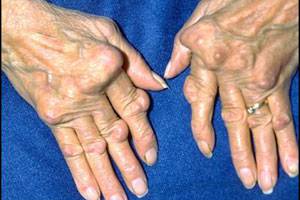 Arthritic hands.  Is there hope?