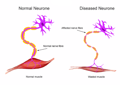 Graphic showing normal and diseased neurone